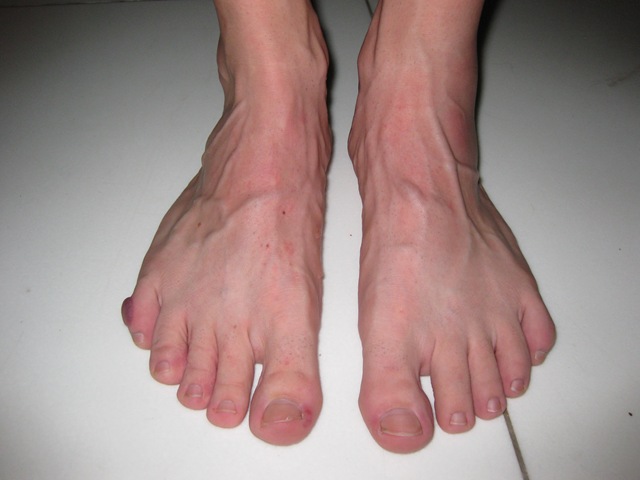 Pictures Of A Sprained Pinky Toe